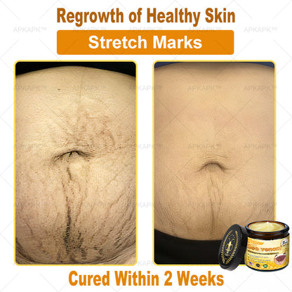 Mayo Clinic Official:🥇🥇 APKAPK™ Bee Venom Skin Treatment Cream, Anti-aging, Hydrating, Skin Repair, Even Tone, Acne and Dark Spot Treatment, Wart and Mole Removal, Psoriasis Relief