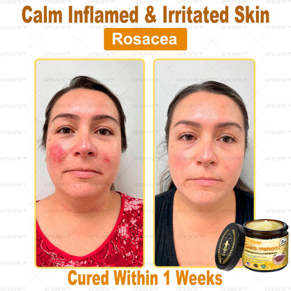 🎁🎁Only 6 jars left! We are offering you an additional 50%discount! Get yourself theperfect skin. If you miss it now, you won't get it until next year.