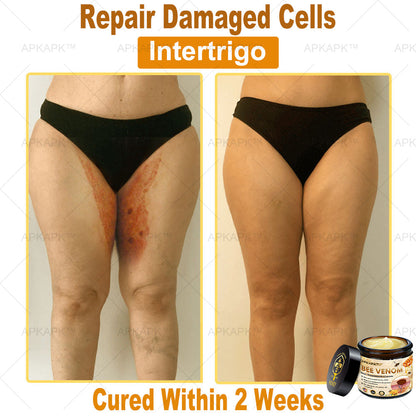 Mayo Clinic Official: APKAPK™ Bee Venom Skin Treatment Cream, Anti-aging, Hydrating, Skin Repair, Even Tone, Acne and Dark Spot Treatment, Wart and Mole Removal, Psoriasis Relief🥇