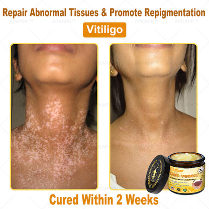 Mayo Clinic Official:🥇🥇 APKAPK™ Bee Venom Skin Treatment Cream, Anti-aging, Hydrating, Skin Repair, Even Tone, Acne and Dark Spot Treatment, Wart and Mole Removal, Psoriasis Relief