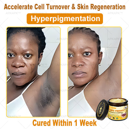 Mayo Clinic Official:🥇🥇 APKAPK™ Bee Venom Skin Treatment Cream, Anti-aging, Hydrating, Skin Repair, Even Tone, Acne and Dark Spot Treatment, Wart and Mole Removal, Psoriasis Relief